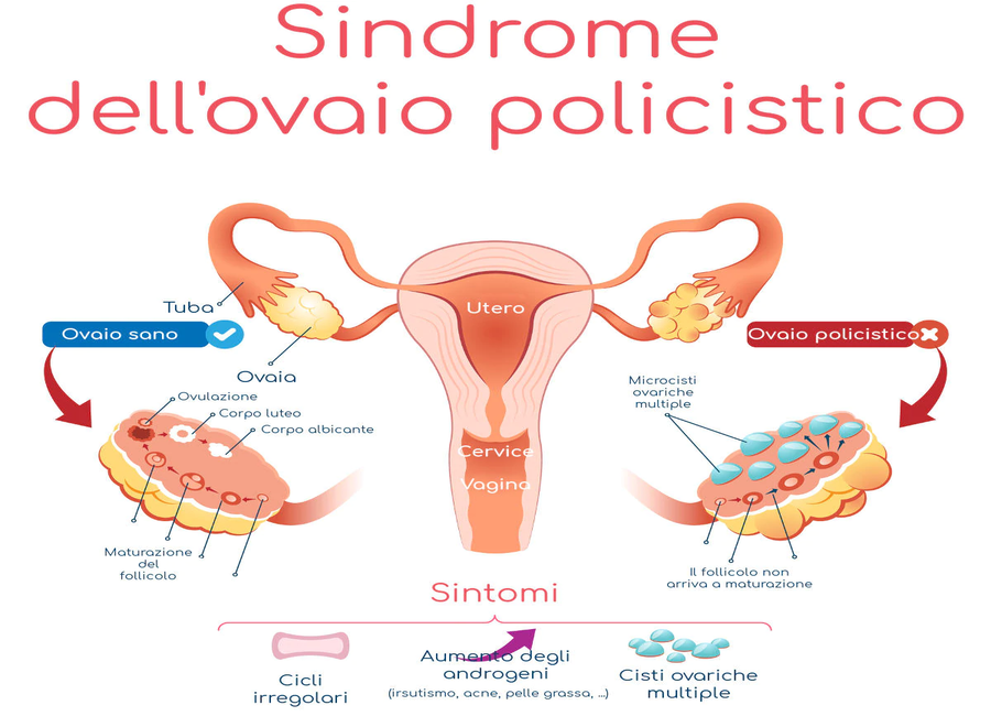La Sindrome Dell Ovaio Policistico Ancora Un Tab Xxi Secolo